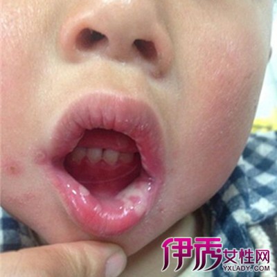 口腔溃疡_嘴里面溃疡怎么办
