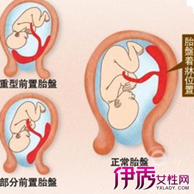 顺产侧切伤口多久愈合|life.yxlady.com-伊秀生活