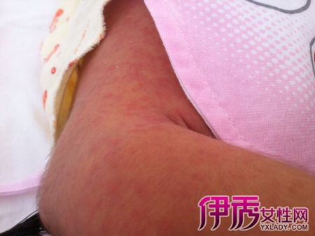 夏天身上长红疹,不痛不痒,怎么治