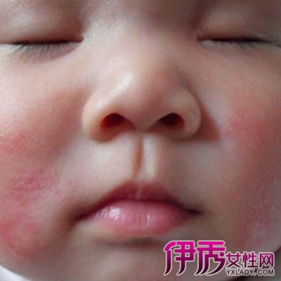 小儿湿疹最佳治疗方法|life.yxlady.com