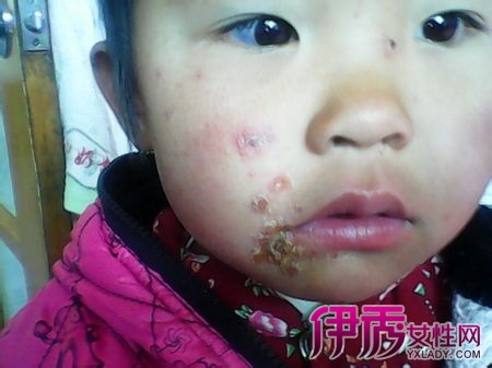 小孩嘴角烂了怎么办|life.yxlady.com
