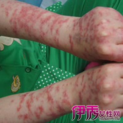 【图】曝光儿童红斑狼疮图片 了解引起红斑狼疮的原因