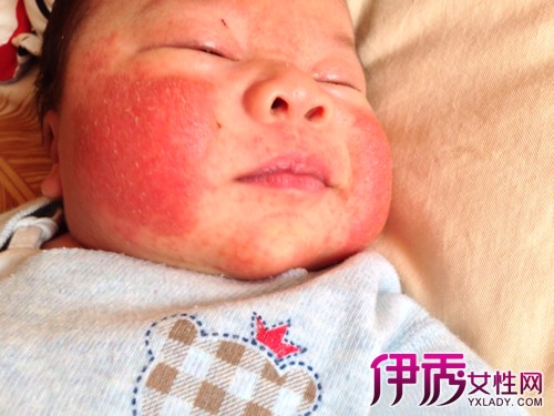 宝宝脸上湿疹怎么办|life.yxlady.com