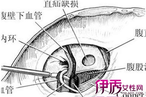 【图】揭秘婴儿腹股沟疝气 临床表现有哪些