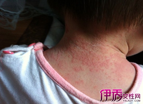 小孩长痱子怎么办|life.yxlady.com