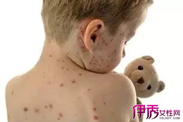 儿童水痘传染吗|life.yxlady.com-伊秀生活小常识