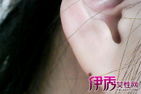 【图】女人耳朵上长痣代表什么? 为你解读痣背后的意义