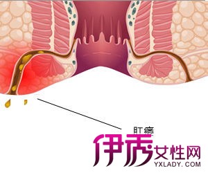 男性肛瘘怎么治疗效果好?