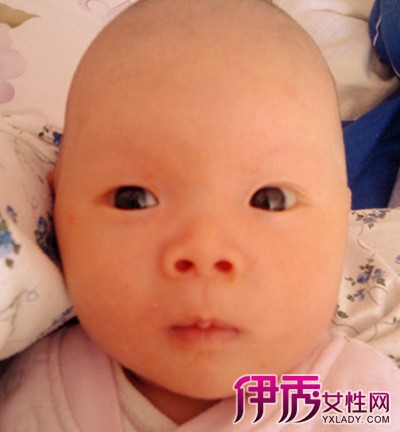 <em>孩子</em>有<em>不长头发</em>的地方咋回事|life.yxlady.com-伊