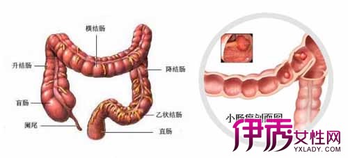 【图】小肠癌的早期症状是什么? 3个步骤教你预防肠癌