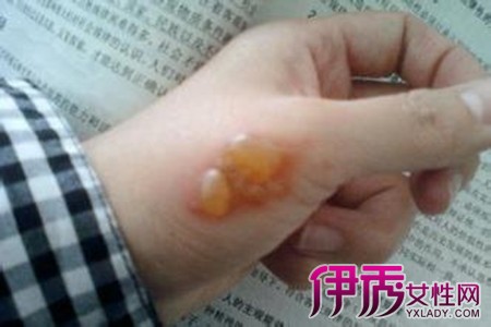 手起泡可见于真菌感染,烧烫伤,过敏等因素,最好先做消毒的处理,建议