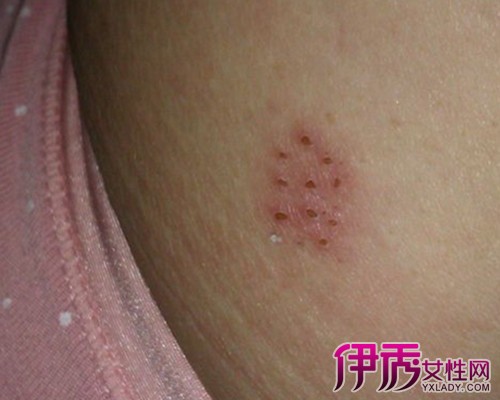 带状疱疹不能吃什么|life.yxlady.com