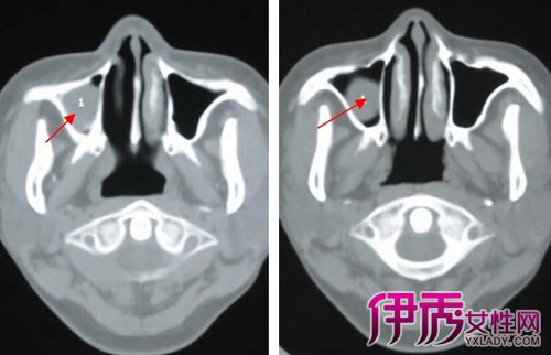 【图】上颌窦囊肿症状是什么? 上颌窦囊肿应该怎么治?