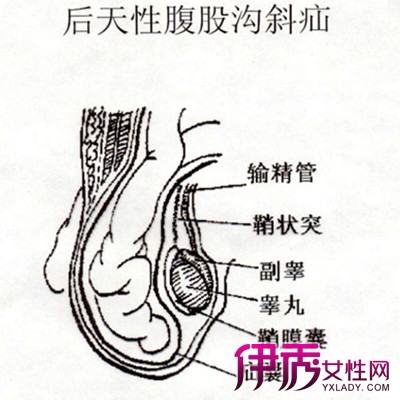 【图】腹股沟疝气症状有哪些? 独家揭秘关于该病的治疗方法