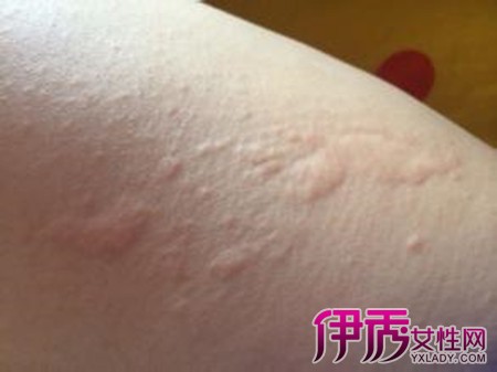 以避免刺激皮肤,更不能用香皂,其中的碱会加重过敏性皮炎的症状