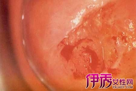 宫颈糜烂二度严重吗|life.yxlady.com