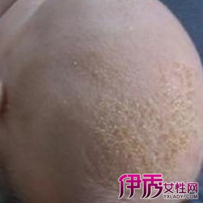 头皮真菌感染症状|life.yxlady.com