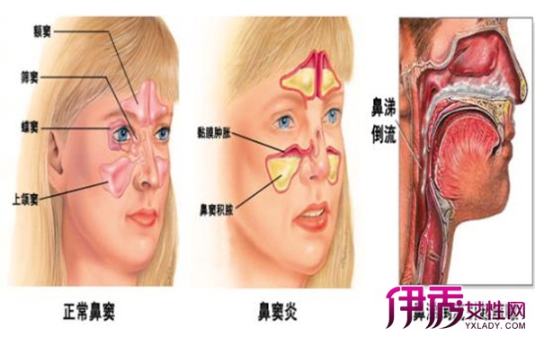 【图】如何治疗鼻窦炎呢 不同病因的治疗法