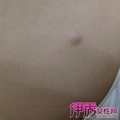 【图】大腿内侧有个硬疙瘩的病因 3个方面应对疙瘩的形成