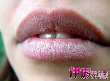 吃辣椒嘴唇肿怎么消肿