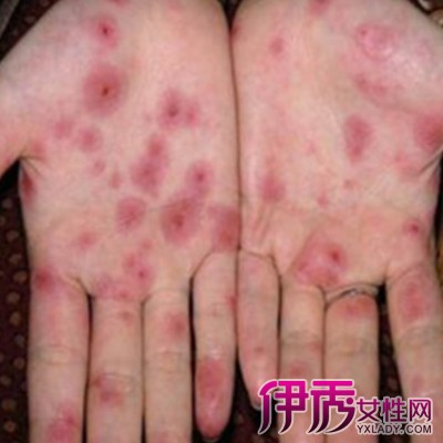 【图】性病的症状有哪些呢 2招预防知识须知道