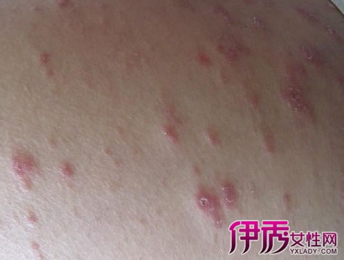扁平苔藓_扁平苔藓治