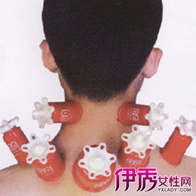 拔火罐能治颈椎病|life.yxlady.com-伊秀生活小常
