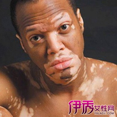 白癜风会传染吗|life.yxlady.com