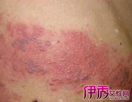 艾滋病带状疱疹图片|life.yxlady.com