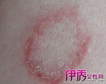 艾滋病皮肤全身图片