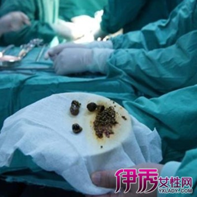 胆结石治疗方法|life.yxlady.com-伊秀生活小常识