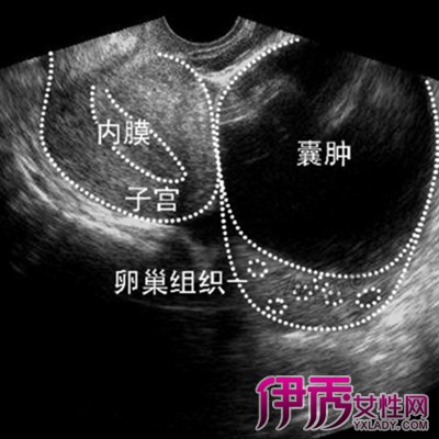 卵泡囊肿|life.yxlady.com