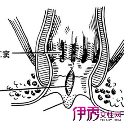 【图】肛裂自愈病因 盘点多种治疗方法