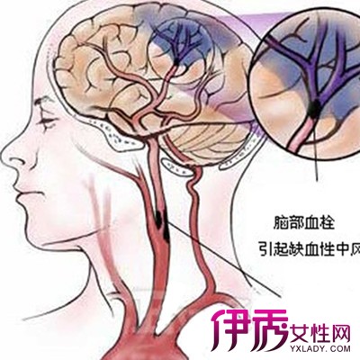 脑血管堵塞怎么治疗|life.yxlady.com-伊秀生活小常识