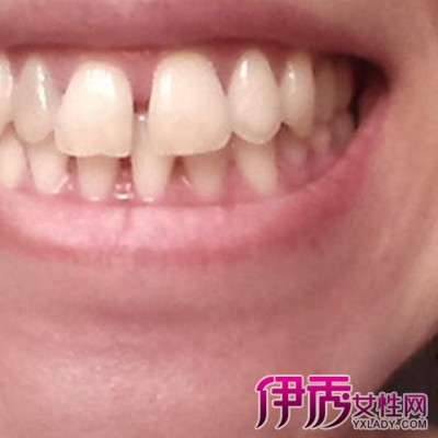 牙缝大怎么办|牙缝大能补吗?牙缝大怎么办