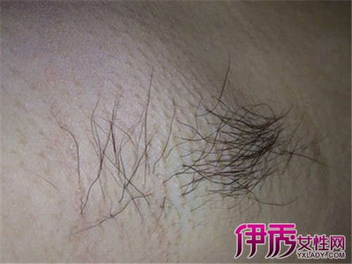 腋下淋巴肿大指淋巴结因内部细胞增生或肿瘤细胞浸润而体积增大的