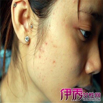 两腮长痘痘是什么原因|life.yxlady.com