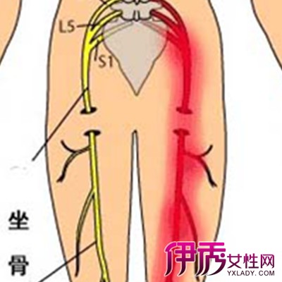 【图】臀上皮神经炎怎么治 经针灸治疗后痊愈