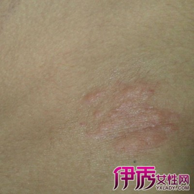 寻麻疹如何治疗|life.yxlady.com-伊秀生活小常识