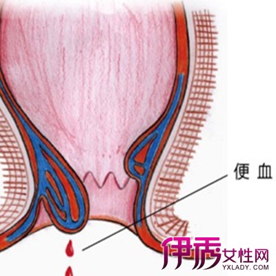 大便出血是指排便时肛门流出血液,会血液随大便排出,很多患者发现有