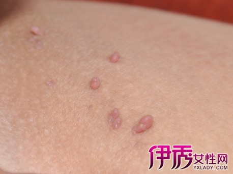 疥虫最怕什么-疥疮会自愈吗-得了疥虫早期的图