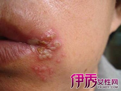 嘴角烂了是什么原因|life.yxlady.com