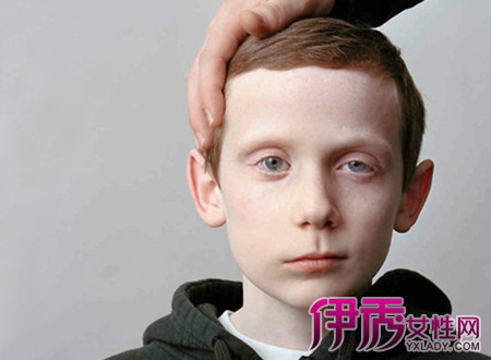 面瘫怎么治疗最快|life.yxlady.com-伊秀生活小常