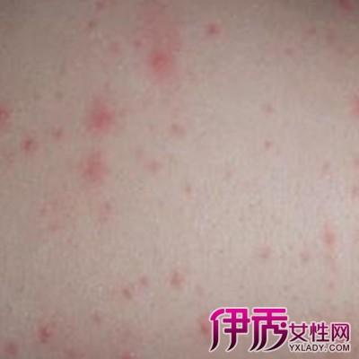 荨麻疹的有效中医治疗方法是什|life.yxlady.com