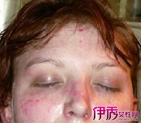 【图】女人梅毒图片展示 揭秘其详细防治措施