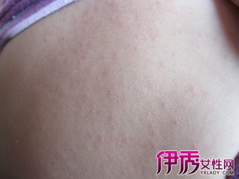 疹子是由病毒引起的一种常见的急性传染病.