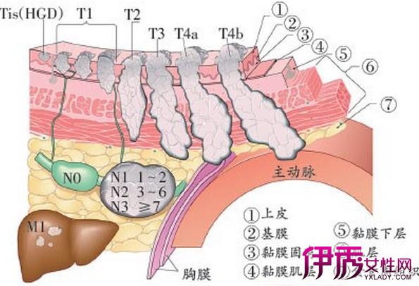 早期食道癌能治愈|life.yxlady.com