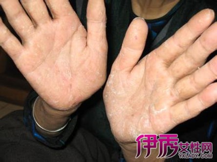 治疗牛皮癣的中成药|life.yxlady.com