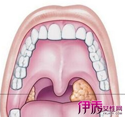 急性扁桃体炎的症状|life.yxlady.com