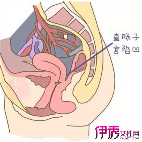 【图】直观子宫直肠陷凹 帮你分析导致陷凹的原因